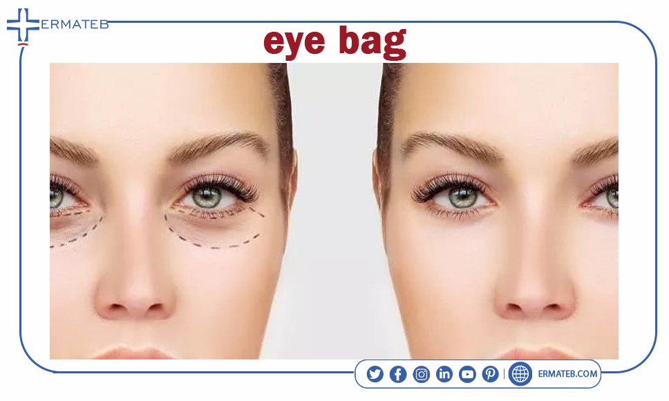 before and after eye bag